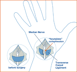 Carpal_Image3