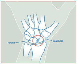 Wristsprains_image2