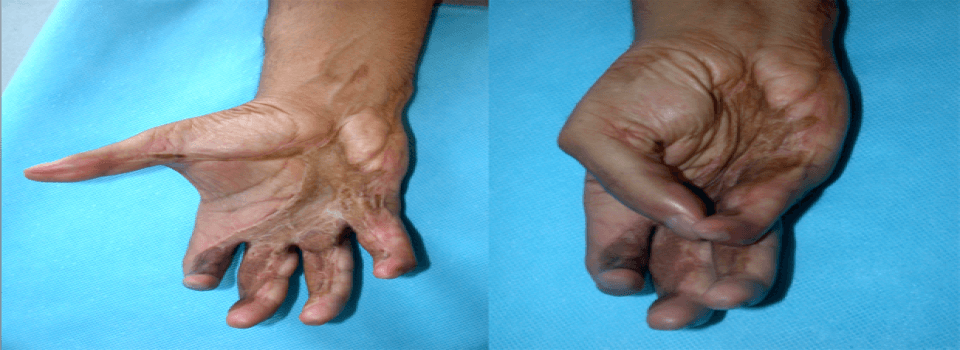 degloving-injuries-symptoms-of-degloving-injuries-causes-of-degloving